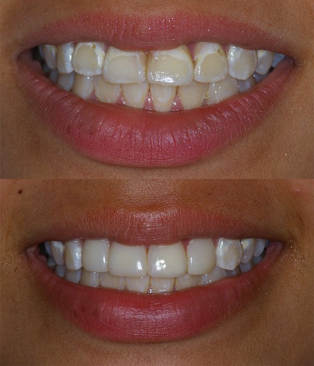 antes y despues de aplicar coronas dentales