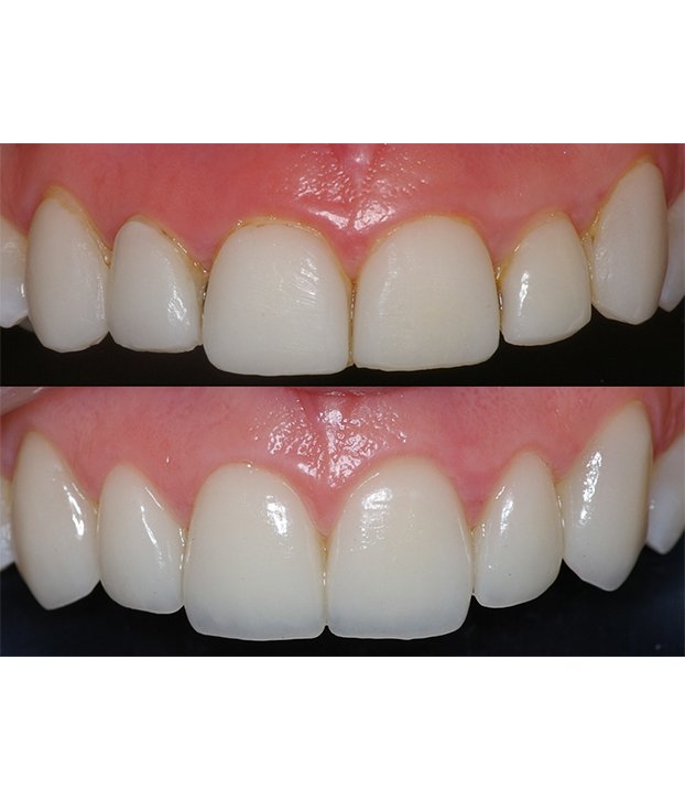 antes y depues de implantes dentales
