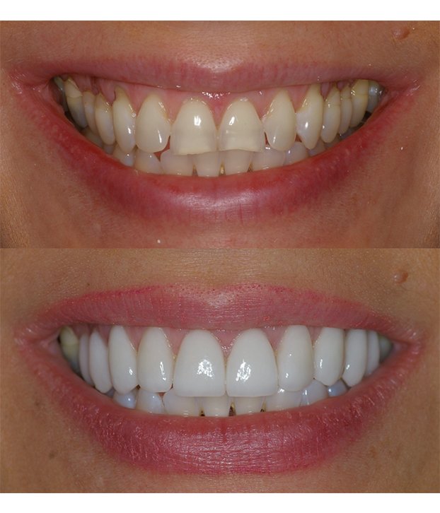 resultados de implantes dentales