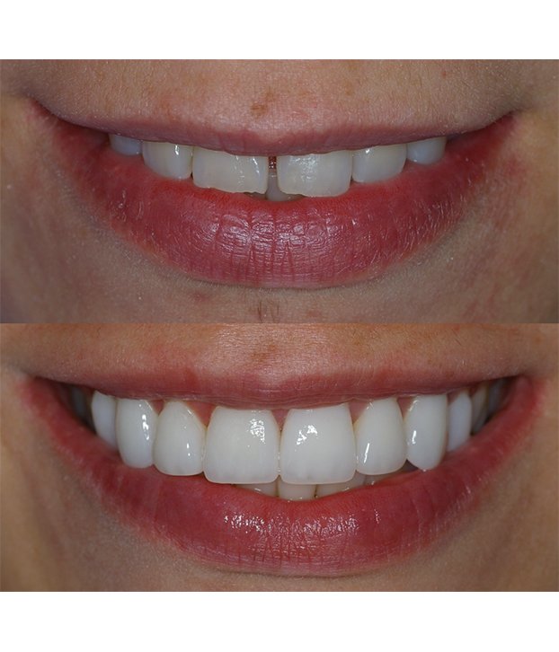 resultados tratamiendo de coronas dentales