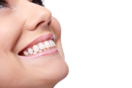 Carillas dentales