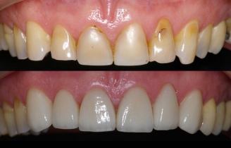 resultado de tratamiento carillas dentales