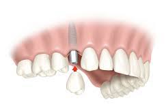 que es un implante dental