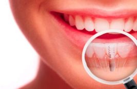 implantes dentales en monterrey